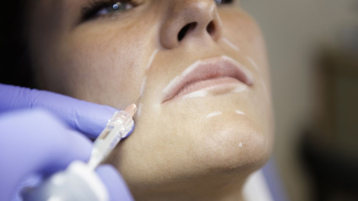 infiltraciones de acido hialuronico tratamiento anti arrugas