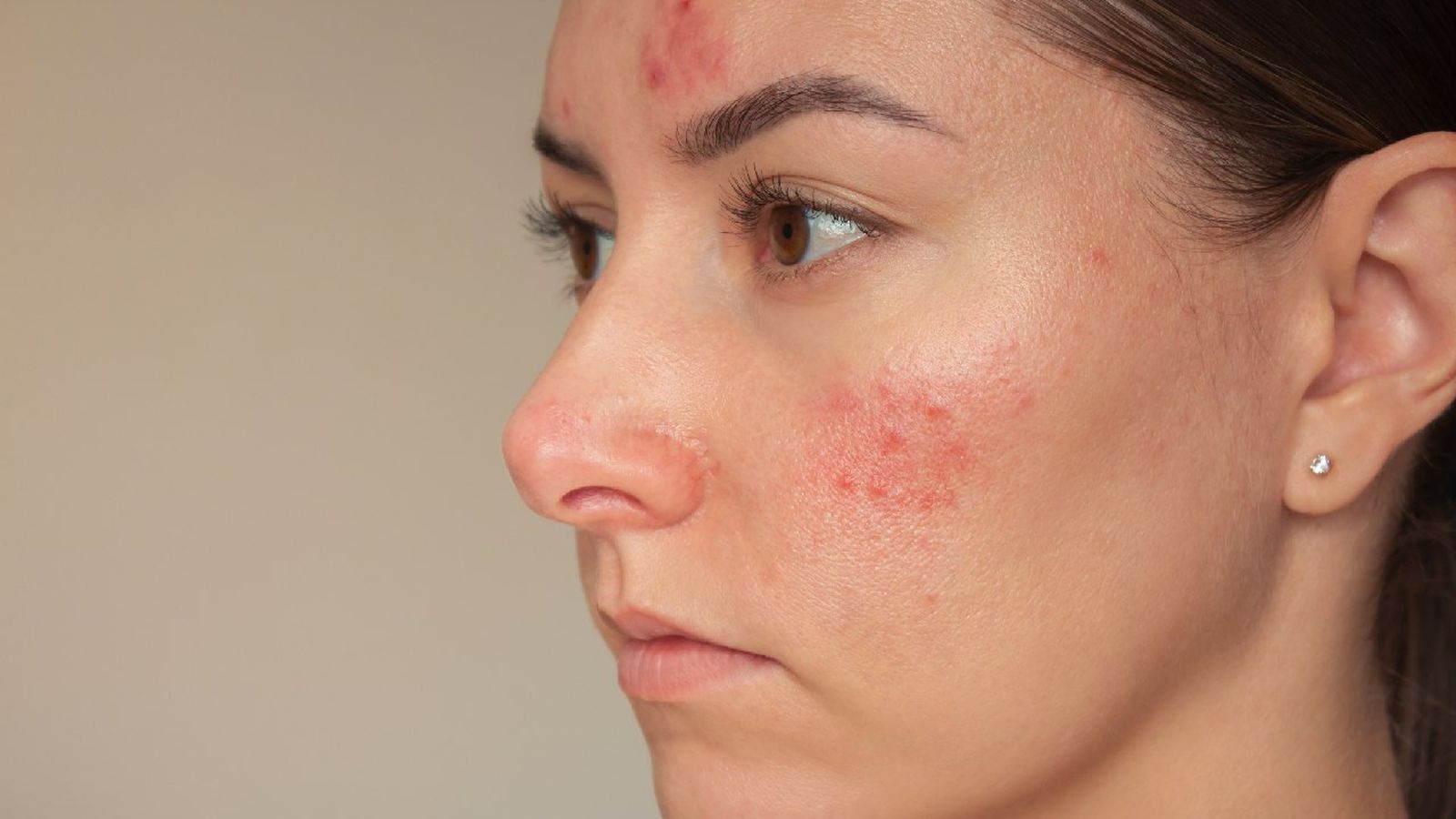 Acné con rosácea