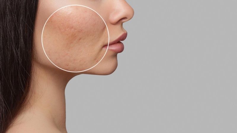 El retinol regula la producción de sebo del rostro