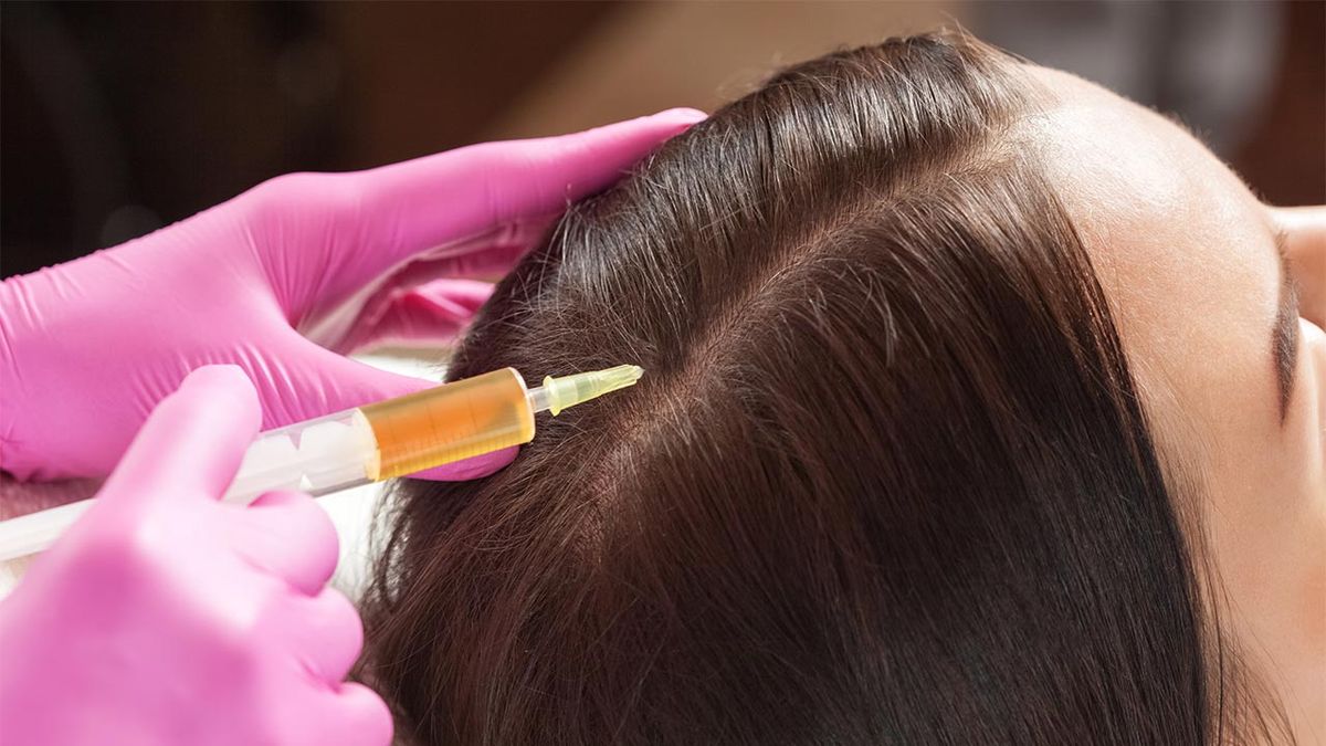 belleza PRP capilar tratamiento plasma rico plaquetas caida cabello inyecciones