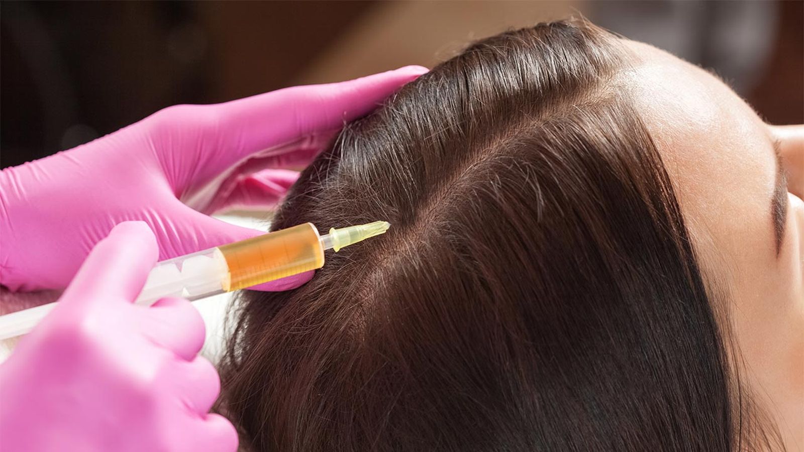 belleza PRP capilar tratamiento plasma rico plaquetas caida cabello inyecciones
