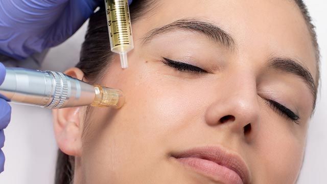 microneedling facial que es como se hace cual precio