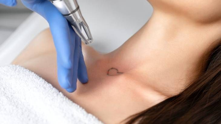 eliminar tatuaje laser