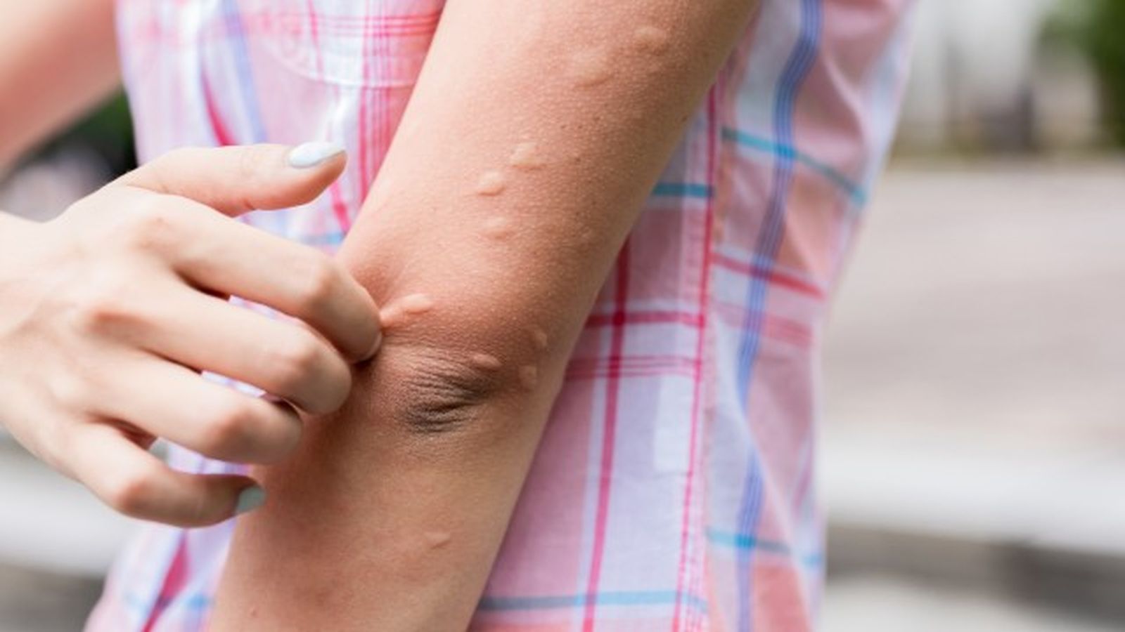 por que pican los mosquitos
