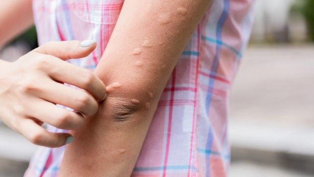 por que pican los mosquitos