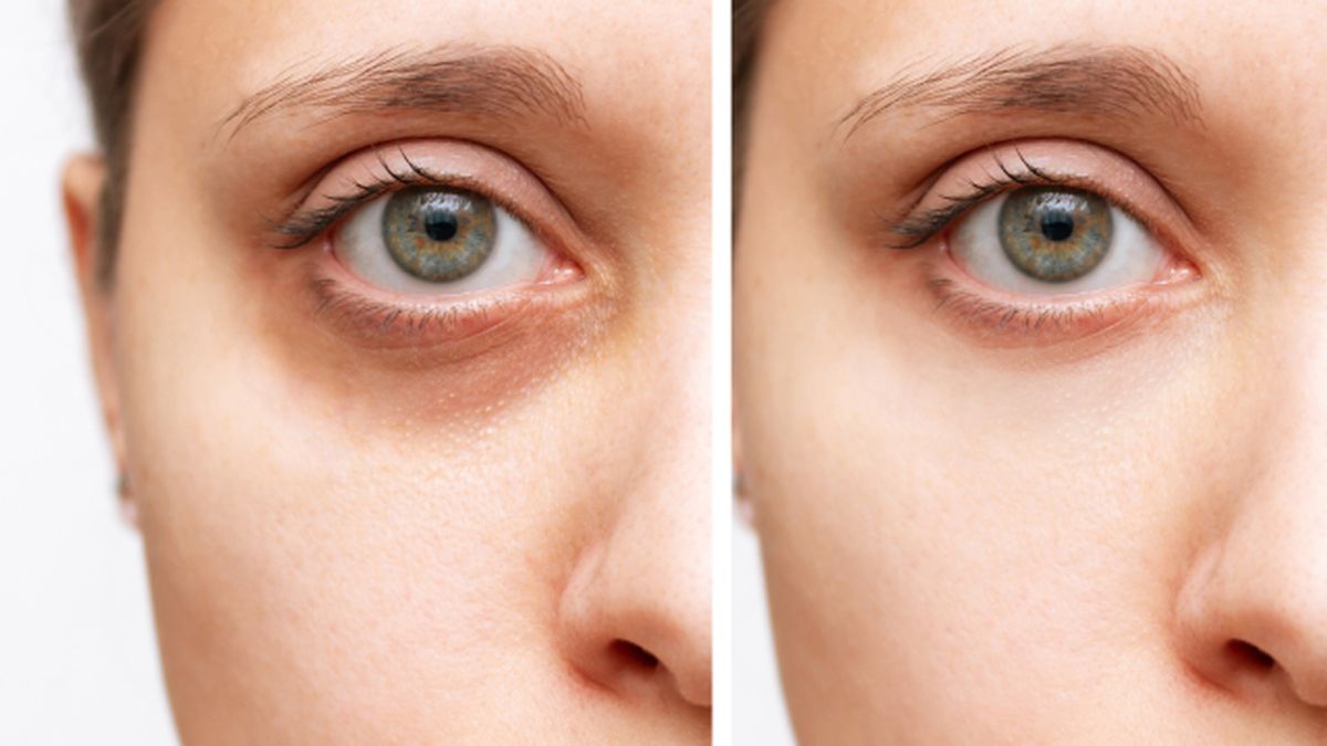 remedios caseros para desinflamar las ojeras y exfoliar y aclarar la piel