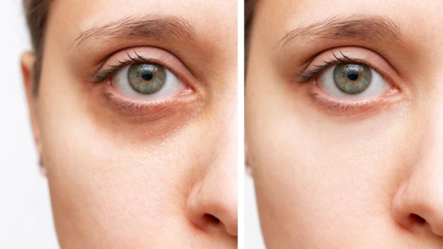 remedios caseros para desinflamar las ojeras y exfoliar y aclarar la piel