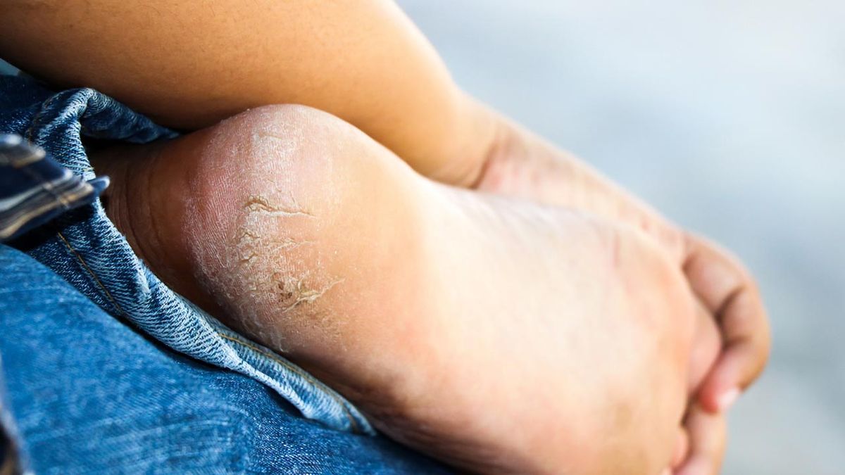 talones agrietados causas remedios casero eficaz