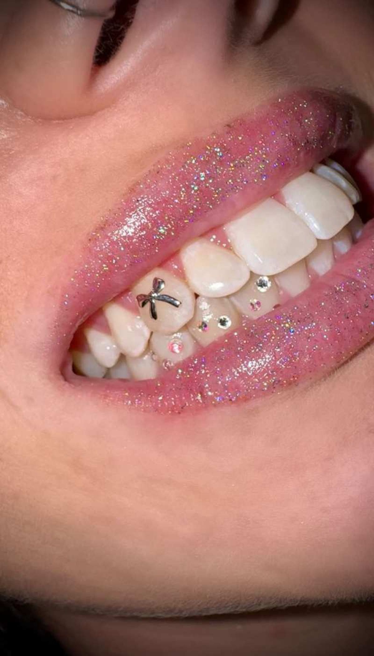 Piercing dental con forma de lazada