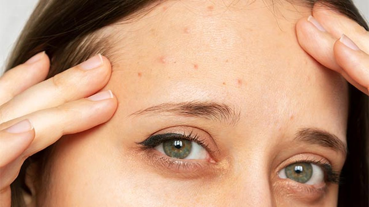 acne en el rostro por que aparece en cada zona y como evitarlo frente