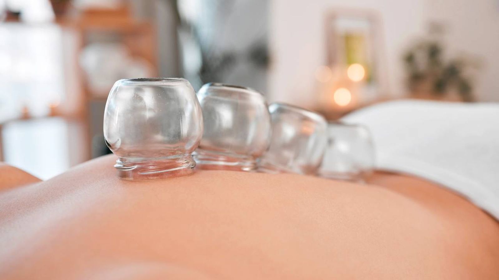cupping ventosaterapia tratamiento rosalia