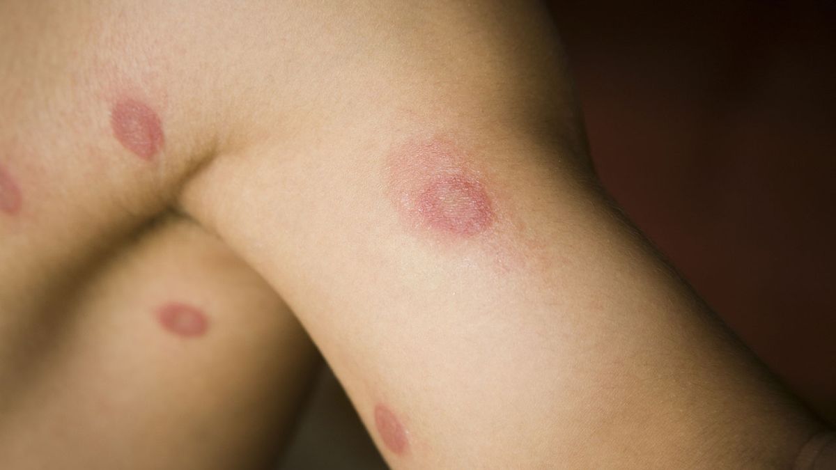 que es la zoonosis y cuales son las mas frecuentes tina