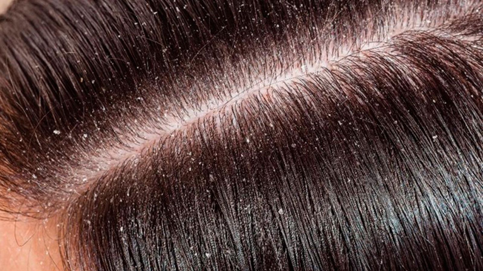 tipos de caspa cabello y como eliminarlos