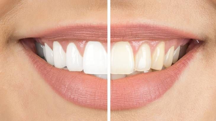 pasta dientes blanqueadora tono dientes