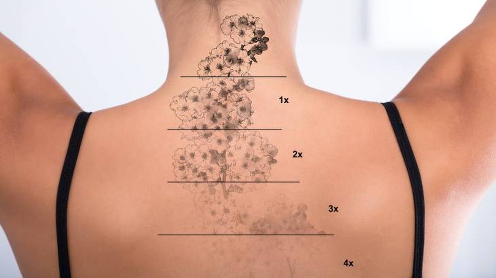 eliminar tatuaje laser proceso 1