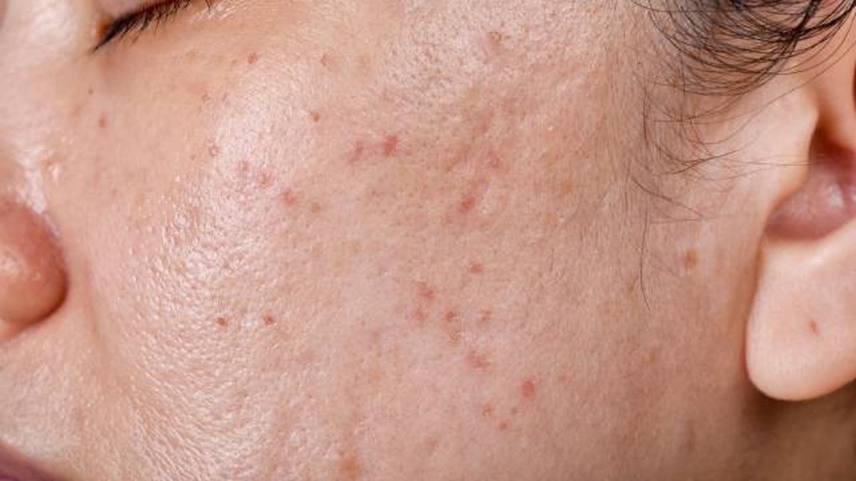 acne quistico causas tratamiento y prevencion 3