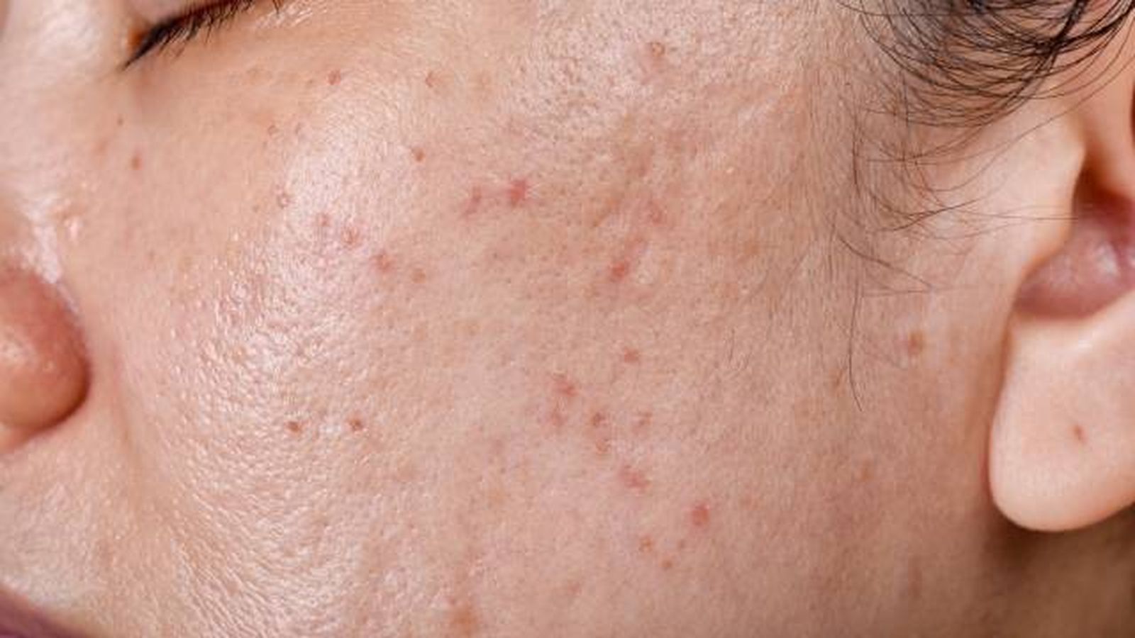 acne quistico causas tratamiento y prevencion 3