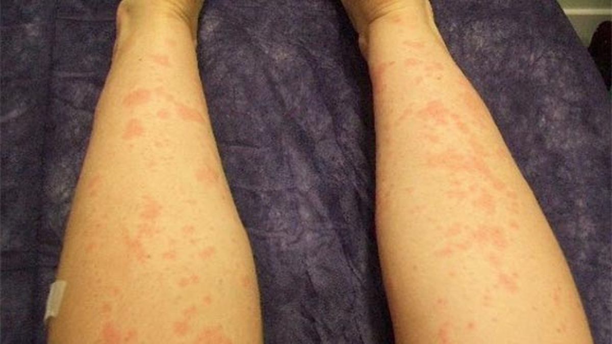 todo lo que debes saber sobre la depilacion laser urticaria