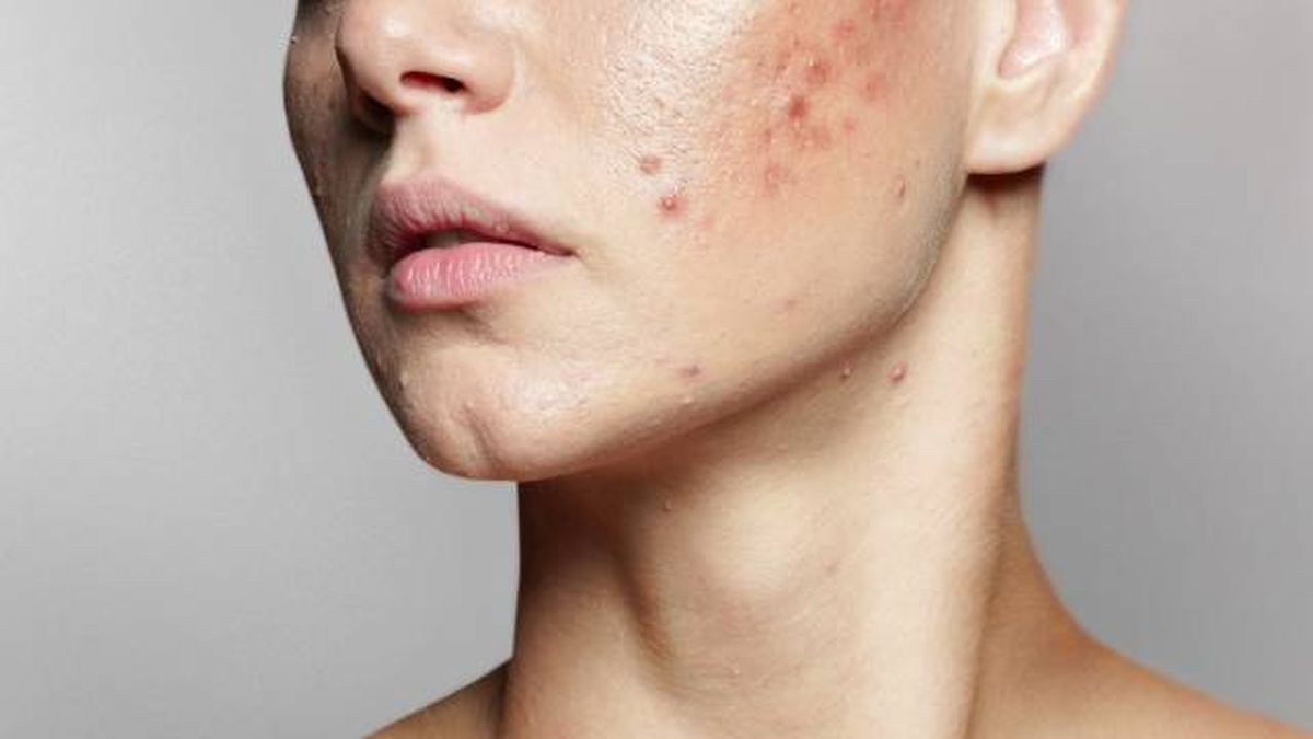 acne quistico causas tratamiento y prevencion 2