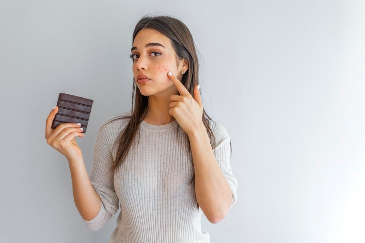 Acné y alimentación saludable