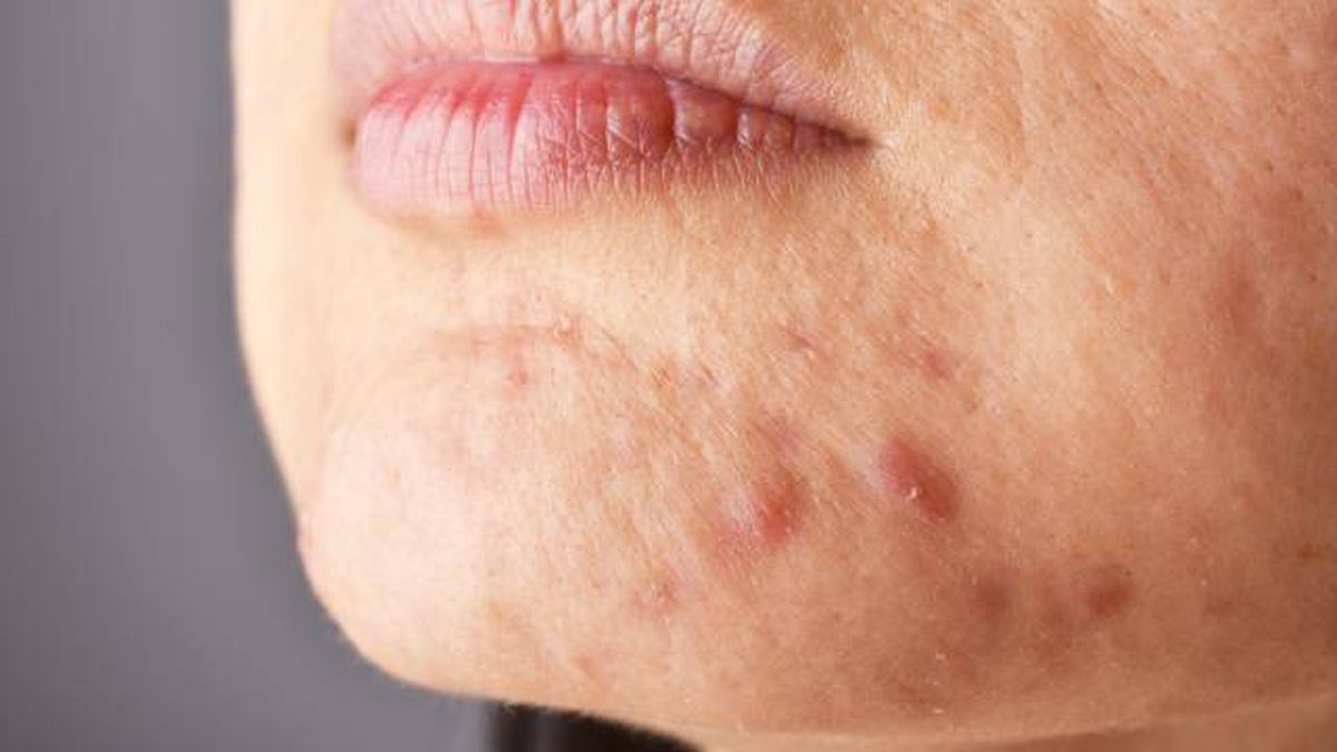 acne quistico causas tratamiento y prevencion 1