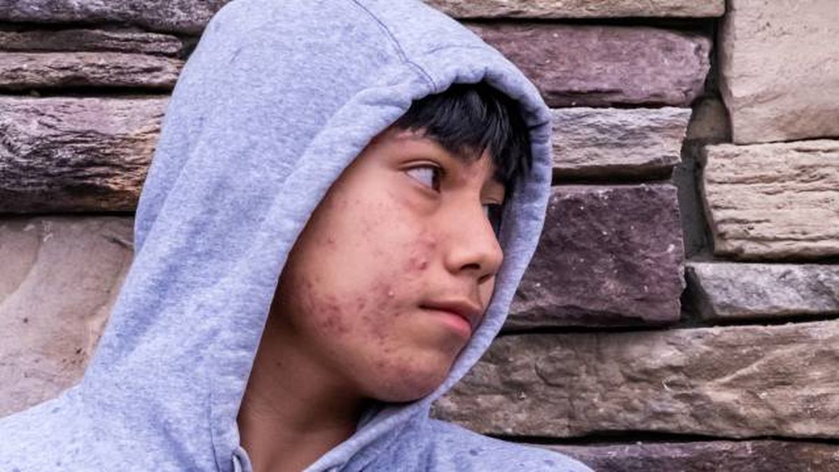 acne quistico causas tratamiento y prevencion 4