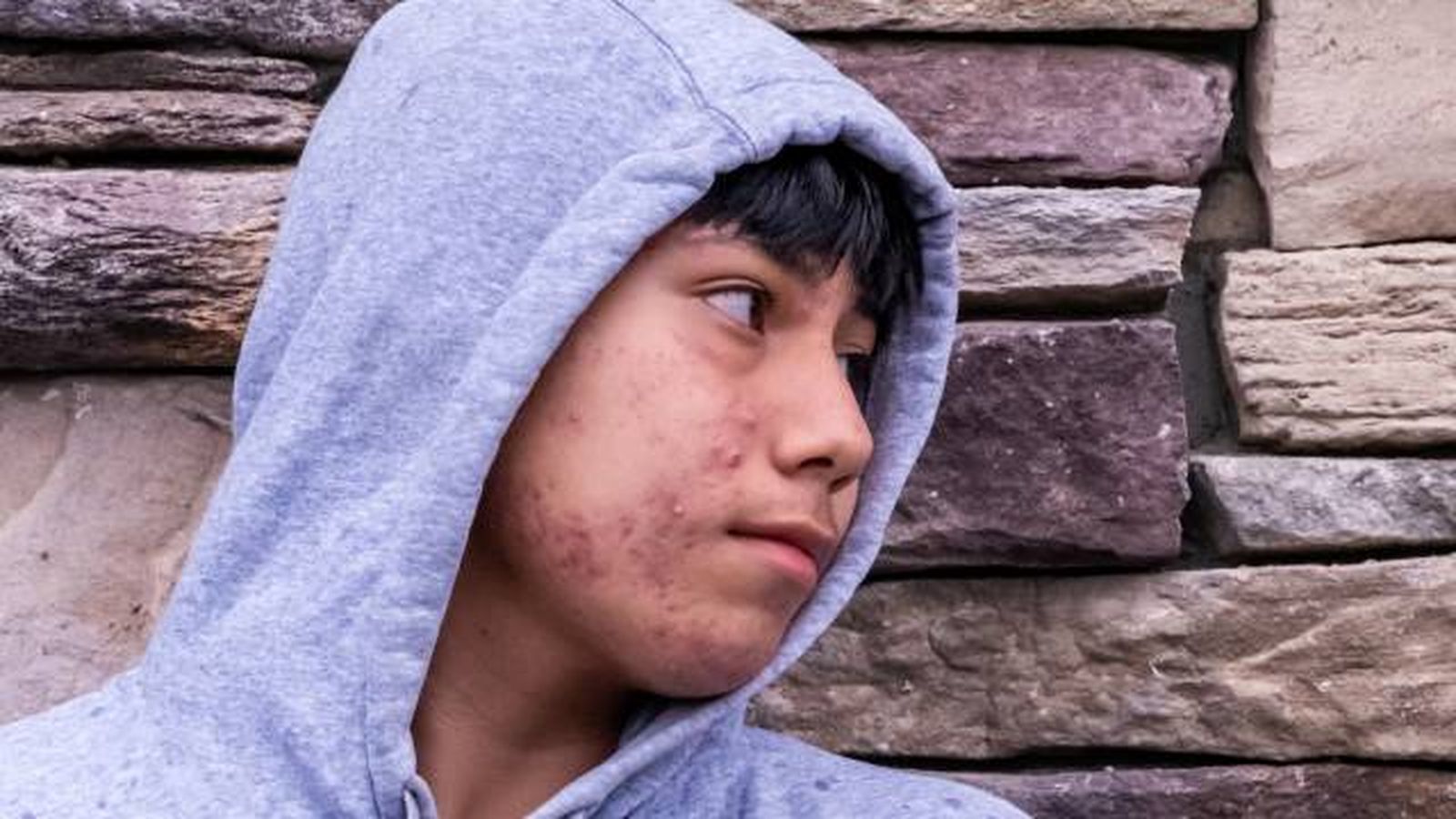 acne quistico causas tratamiento y prevencion 4