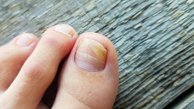 como eliminar hongos en las unas de los pies remedios 1