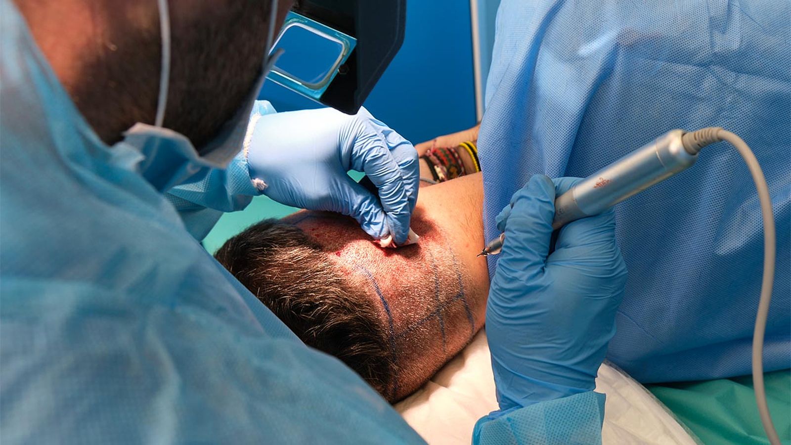 injerto capilar que es como se hace cuidados despues del tratamiento portada