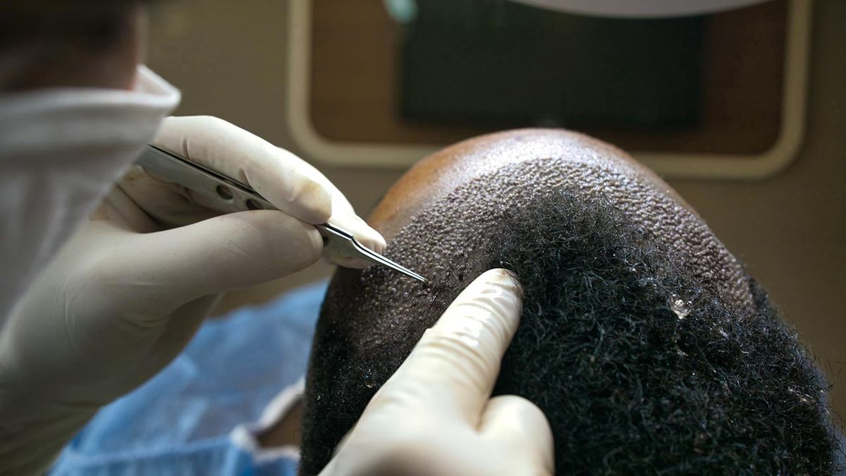 5 preguntas respuestas injerto capilar tratamiento