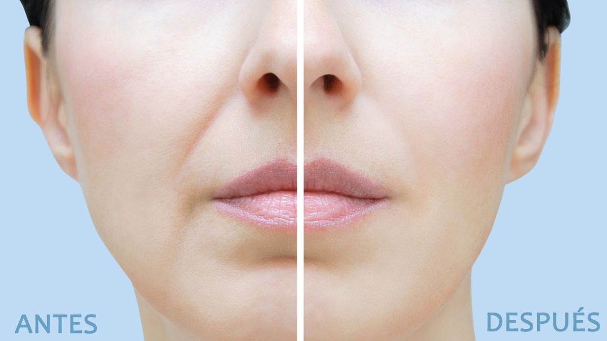 infiltraciones de acido hialuronico antes y despues