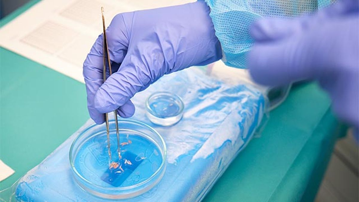 injerto capilar que es como se hace cuidados despues del tratamiento proceso 1