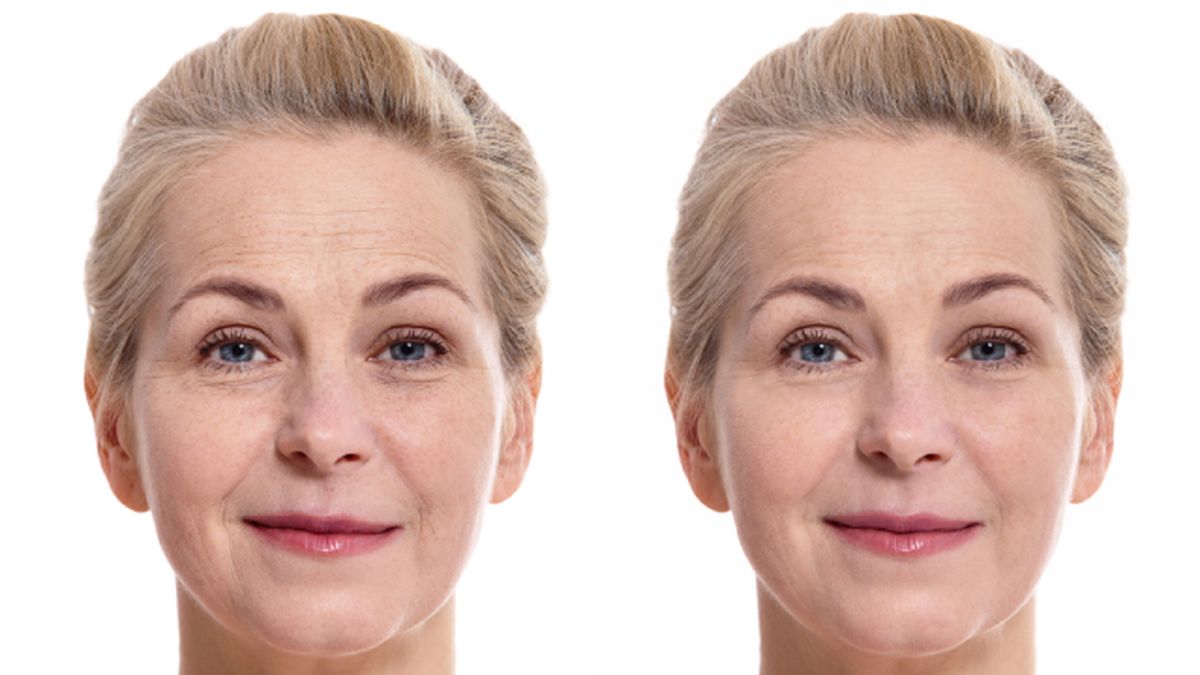lifting facial sin cirugia antes y despues