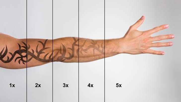 eliminar tatuaje laser proceso