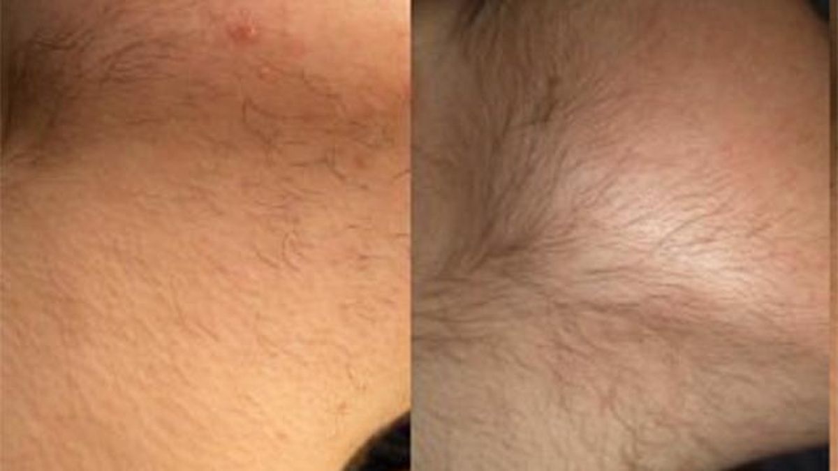 todo lo que debes saber sobre la depilacion laser estimulacion del vello