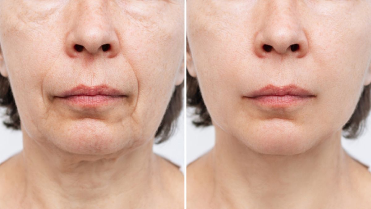 lifting sin cirugia cuello