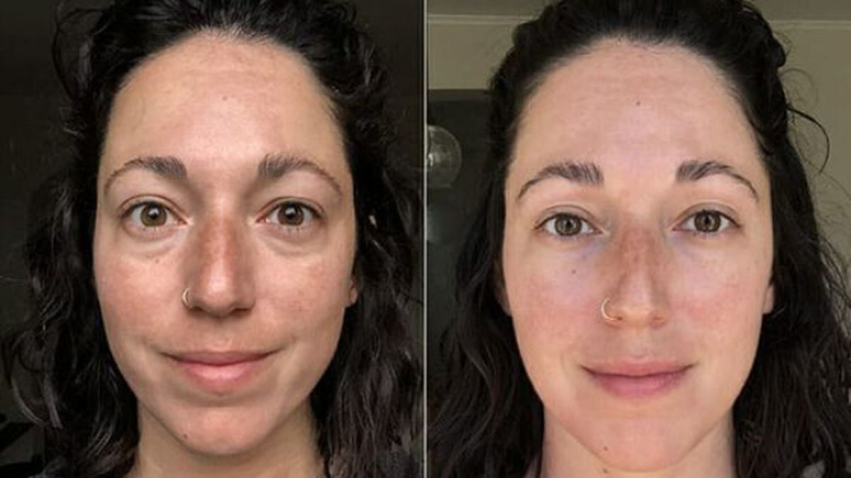 rodillo jade antes y despues