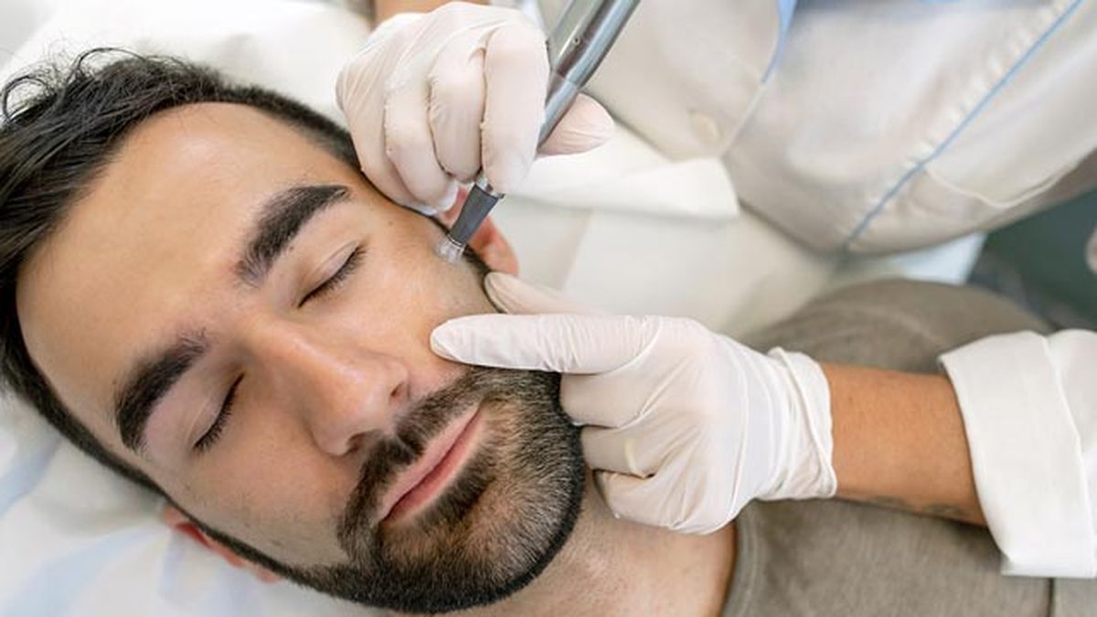 microneedling facial que es como se hace  precio
