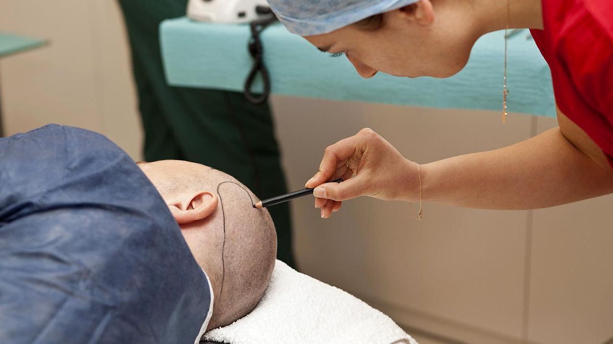 5 preguntas respuestas injerto capilar cirugia